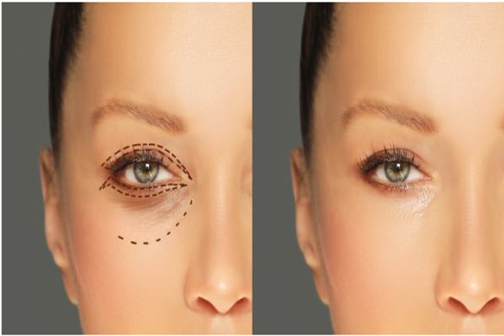 5 Reasons to Consider Blepharoplasty Near Me